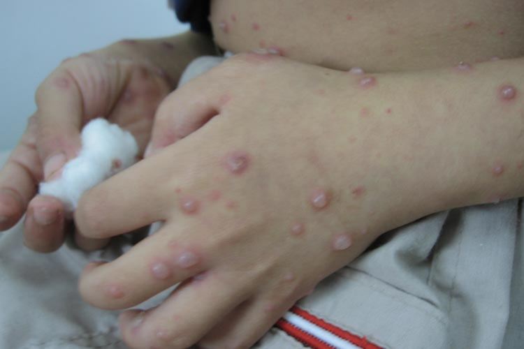 手部水痘图