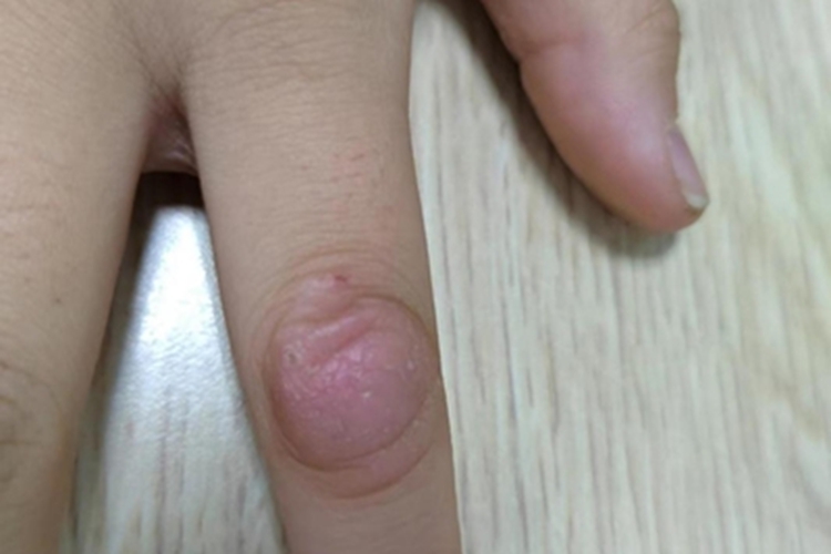 神经性皮炎手指肿图