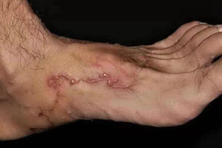 皮肤幼虫移行症脚背丘疹图