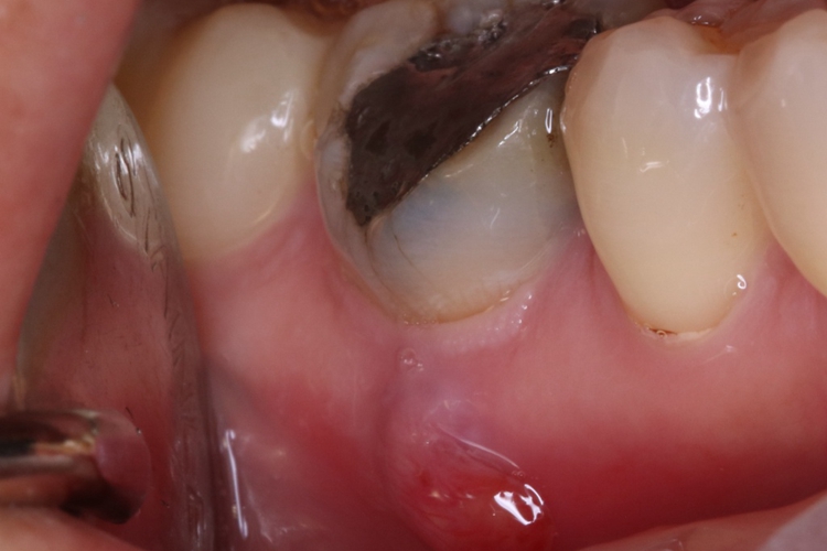 根尖囊肿牙齿症状图