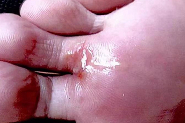 皮肤幼虫移行症脚趾缝渗液图