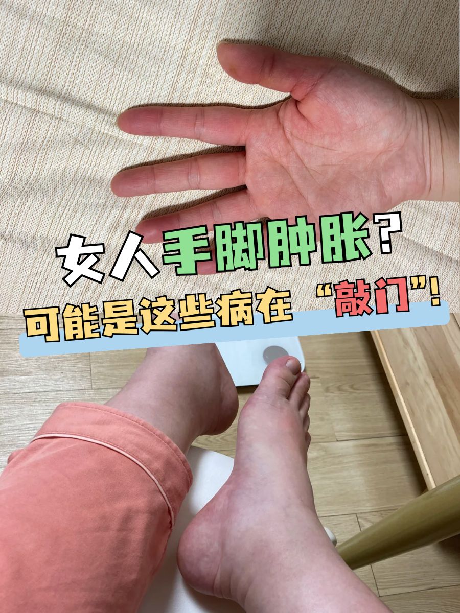 女人手脚肿胀？可能是这些病在 “敲门”！