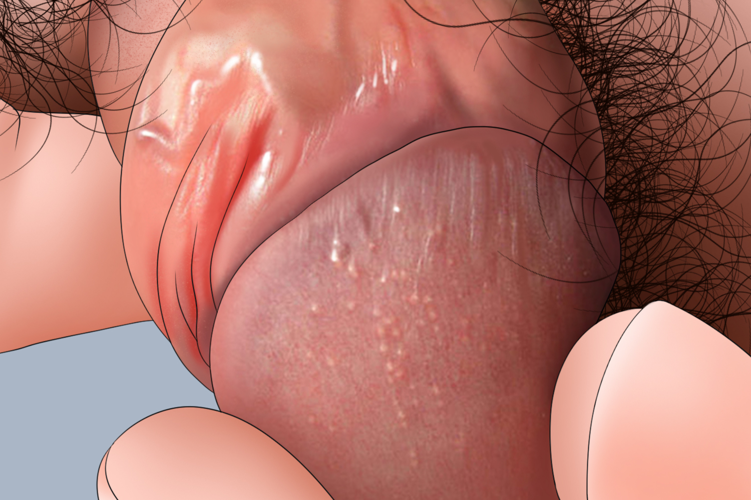 皮脂腺异位症龟头小疙瘩手绘图 皮脂腺异位症龟头小疙瘩手绘图