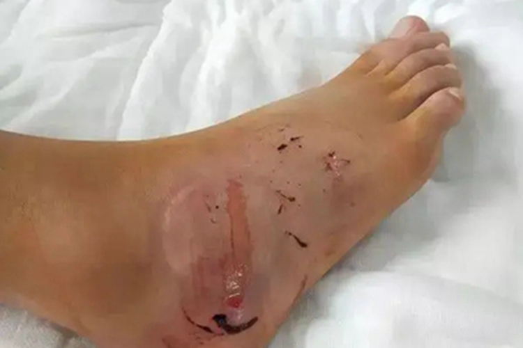 毒蛇咬伤脚部红肿图 毒蛇咬伤脚部红肿图