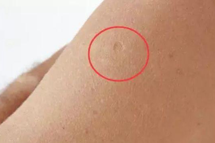 卡介苗卡痕图 卡介苗卡痕图