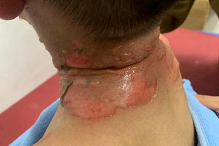 浅Ⅱ度烧伤颈部红斑图