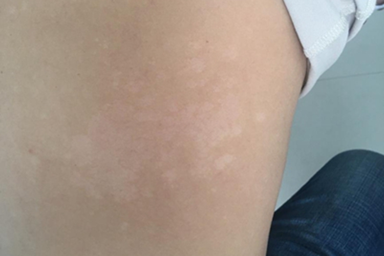 花斑癣背部症状图