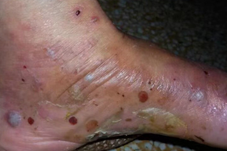 疱疹样皮炎脚部斑图 疱疹样皮炎脚部斑图