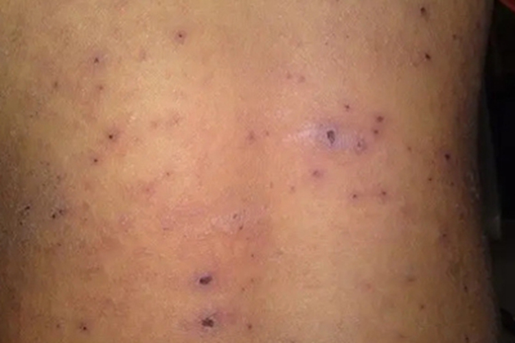 丘疹坏死性结核疹背部症状图