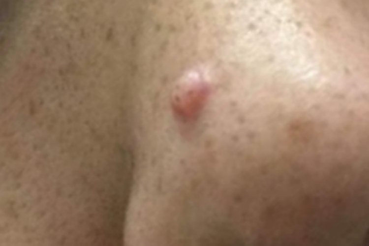 小汗腺汗孔瘤小疙瘩图