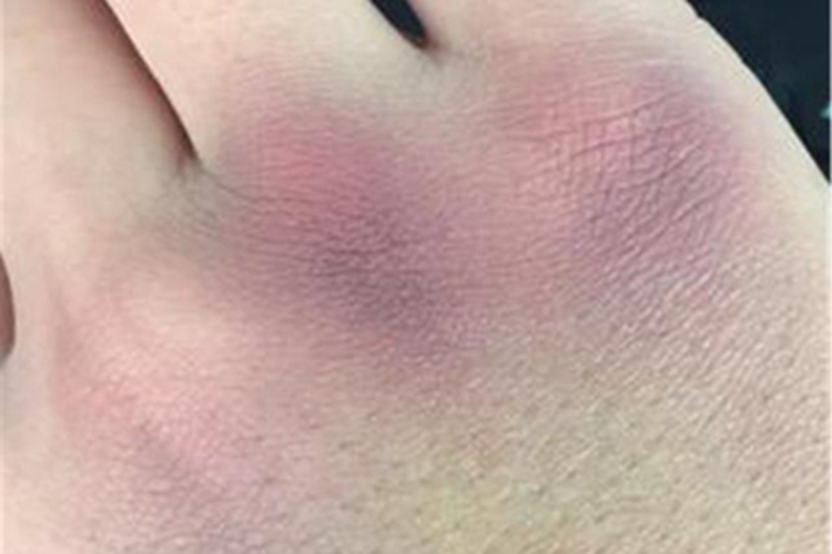 挫伤手背皮肤发紫图