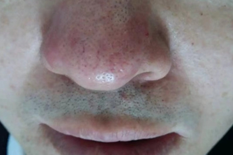 红斑毛细血管扩张型酒糟鼻粗糙图