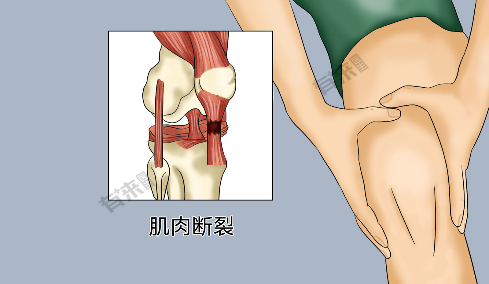 股四头肌肌腱炎症状图片