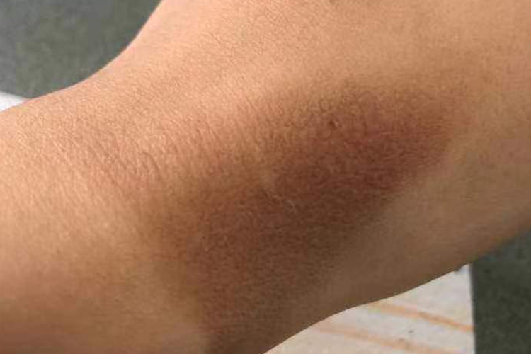 Ⅰ度烫伤痊愈后色素沉着图