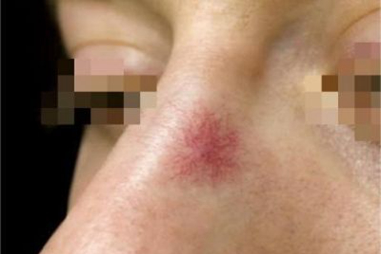 肝硬化鼻部蜘蛛痣图