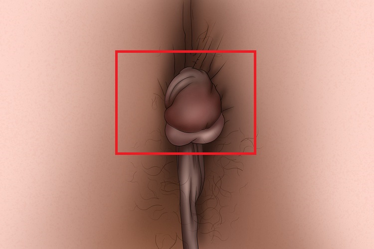 外痔症状图 外痔症状图
