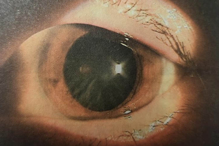 白内障初发期图 白内障初发期图