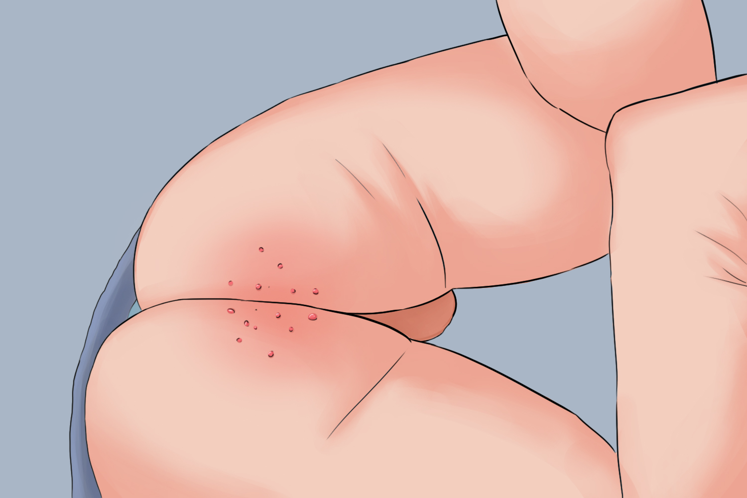 肛门狭窄肛周水疱手绘图