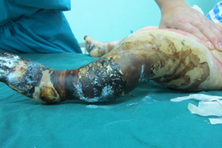 Ⅲ度烧伤腿结痂图 Ⅲ度烧伤腿结痂图