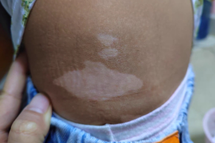 混合型白癜风腰部白斑图