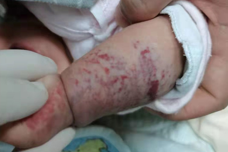 混合型血管瘤图 混合型血管瘤图