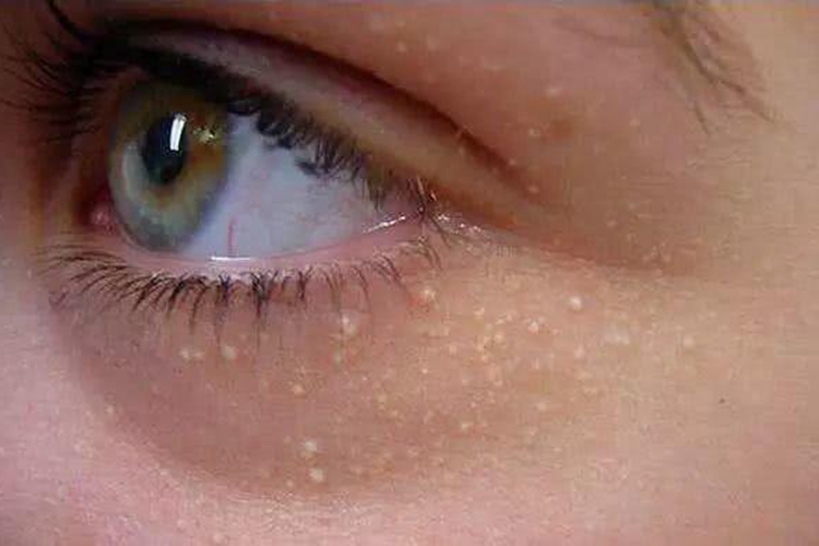 下眼皮粟粒疹图