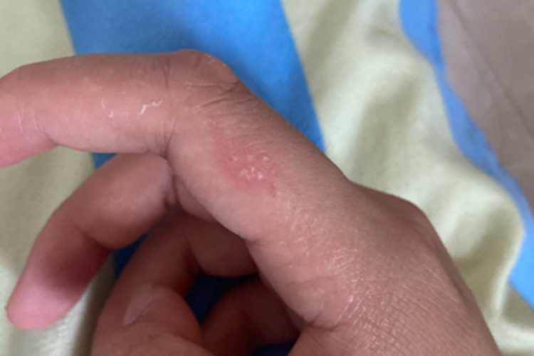 汗疱疹手指症状图 汗疱疹手指症状图