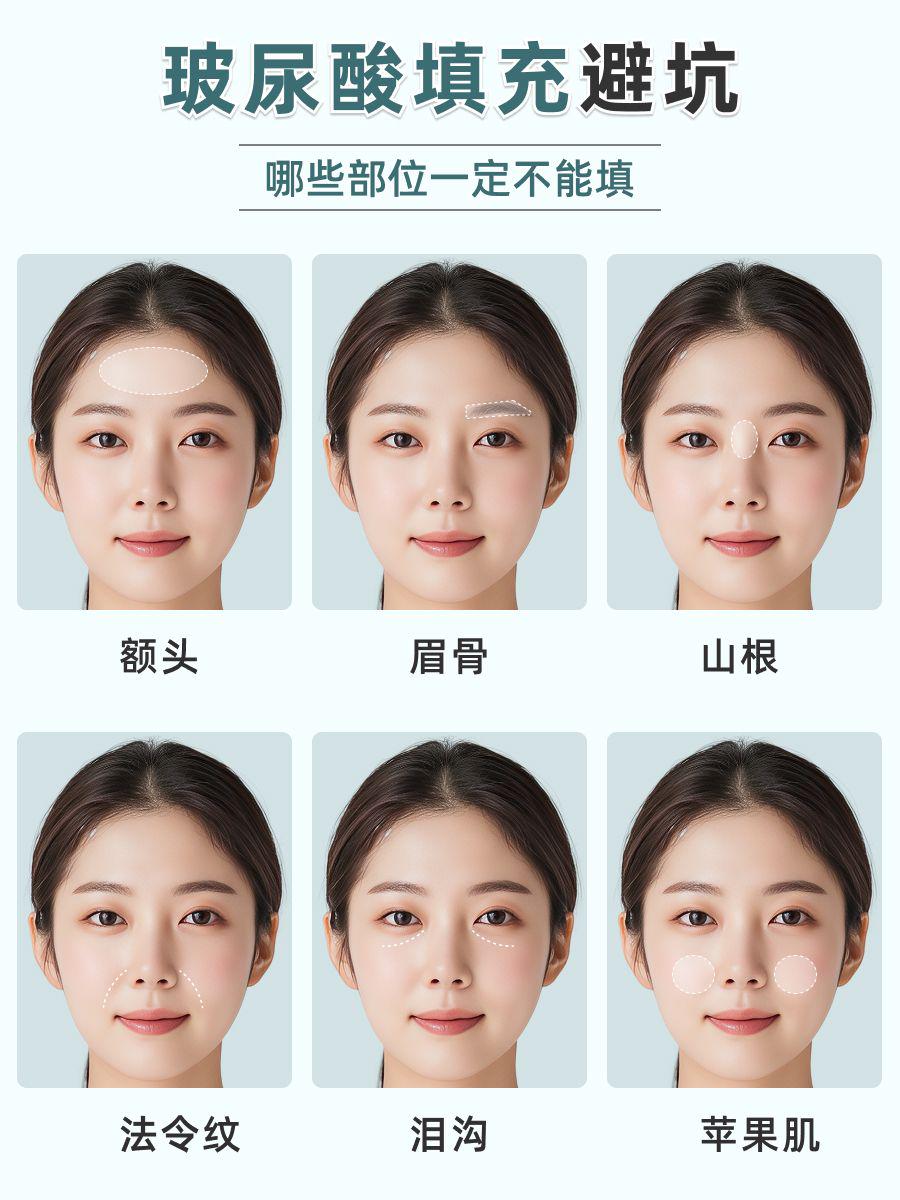 杭州玻尿酸攻略:让你明智选择,安全变美
