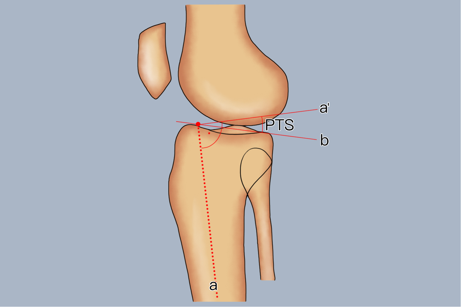 胫骨后倾角图 胫骨后倾角图