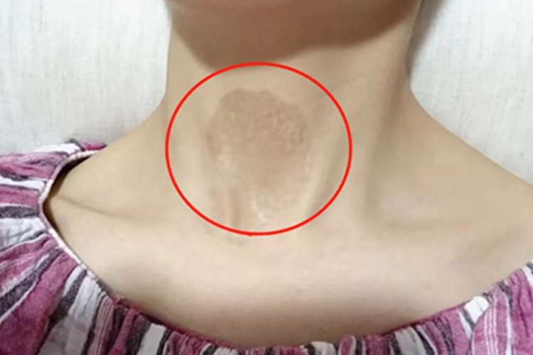 咖啡斑颈部长斑图
