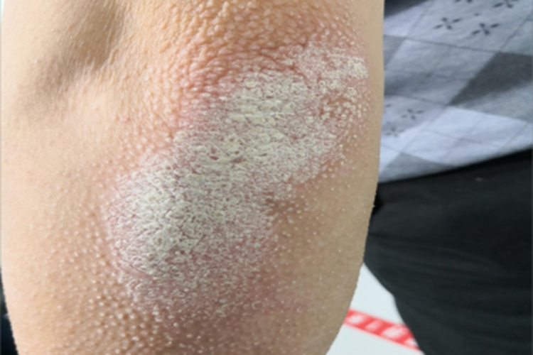 毛发红糠疹胳膊症状图 毛发红糠疹胳膊症状图