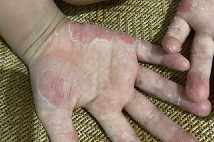 剥脱性角质松解症手掌症状图