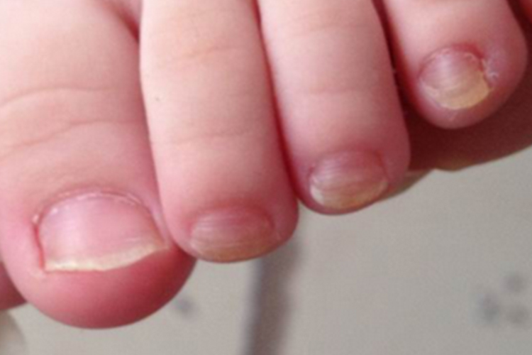 灰指甲早期症状图表现图片