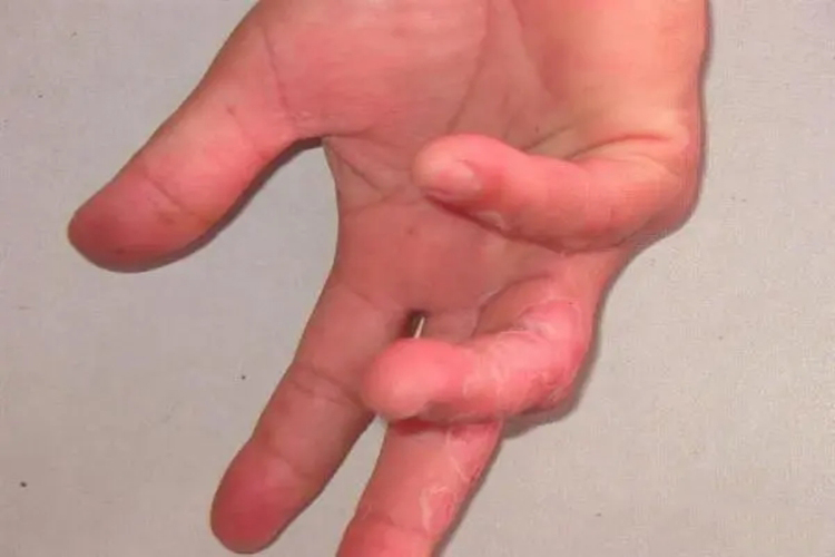 皮肤念珠菌病图 皮肤念珠菌病图