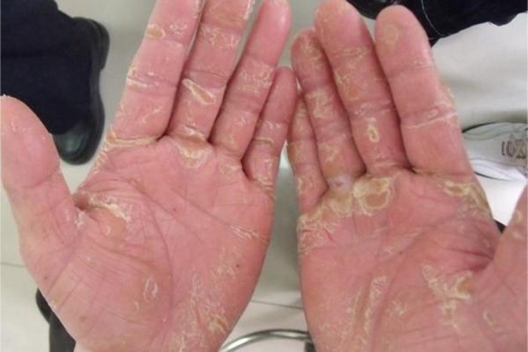 毛发红糠疹性红皮病手掌症状图 毛发红糠疹性红皮病手掌症状图