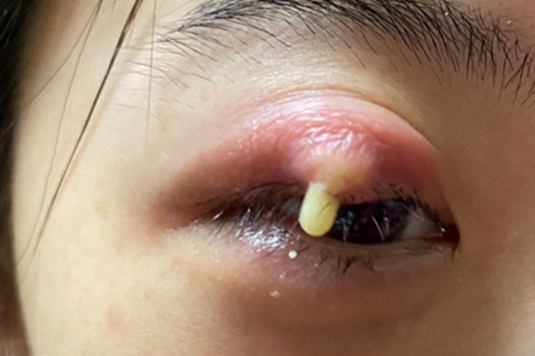 外睑腺炎眼睑脓肿图