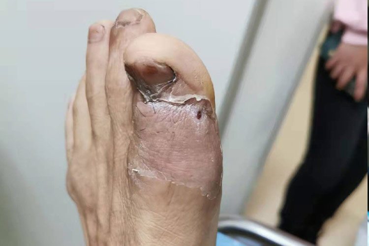 痛风关节部位皮肤脱屑图