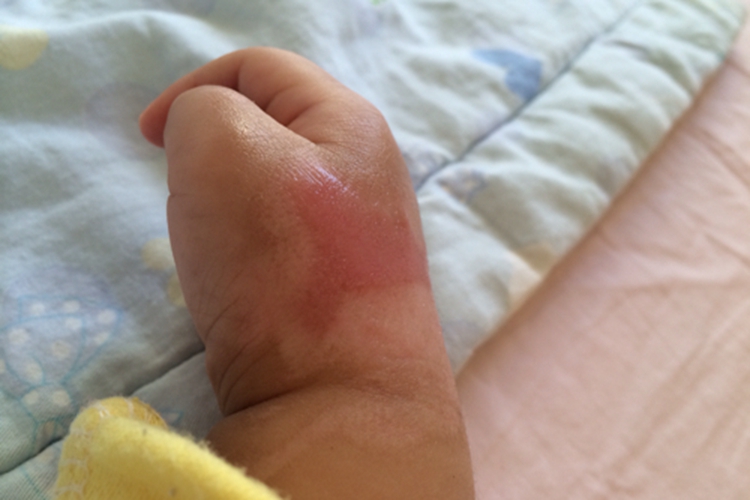 宝宝Ⅰ度烫伤图 宝宝Ⅰ度烫伤图