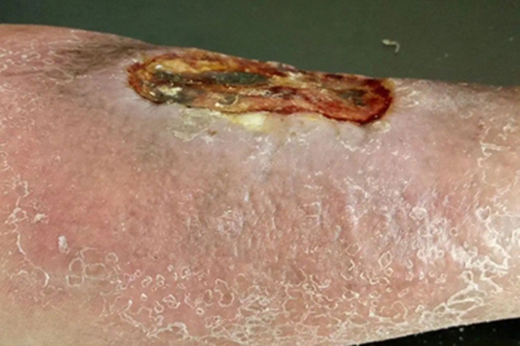 溃疡型坏疽性脓皮病大坑图 溃疡型坏疽性脓皮病大坑图