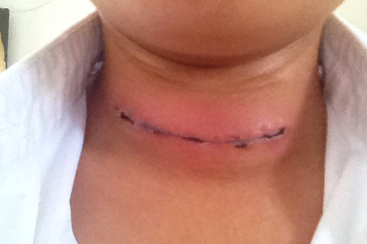 甲状腺术后伤口局部脓肿图