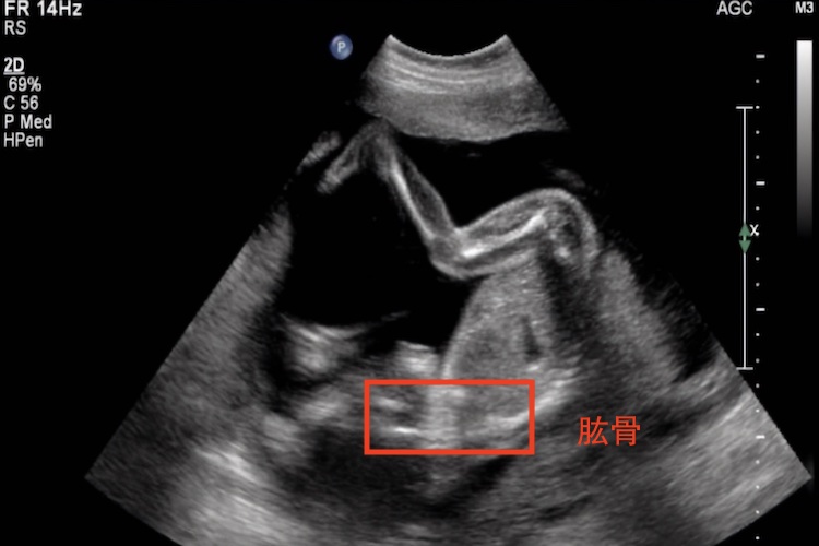 胎儿肱骨影像图 胎儿肱骨影像图