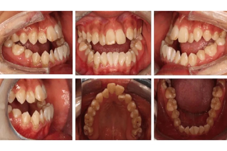 前牙开(牙合)图