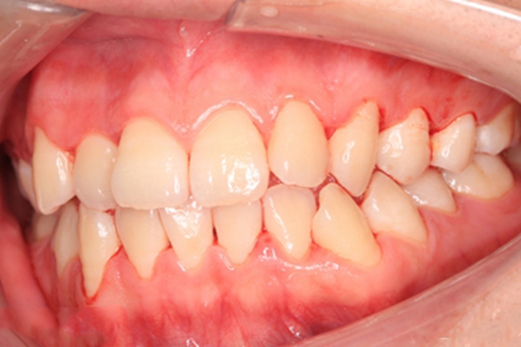 慢性龈炎牙龈出血有血丝图