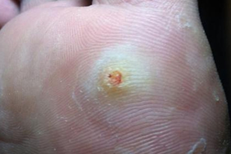 软鸡眼脚底症状图