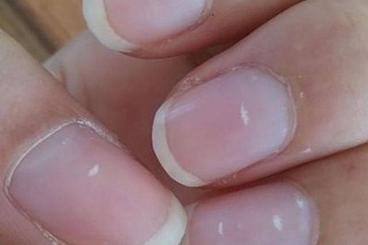 肾不好指甲白斑图 肾不好指甲白斑图