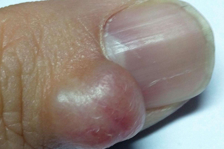 拇指黏液性囊肿图