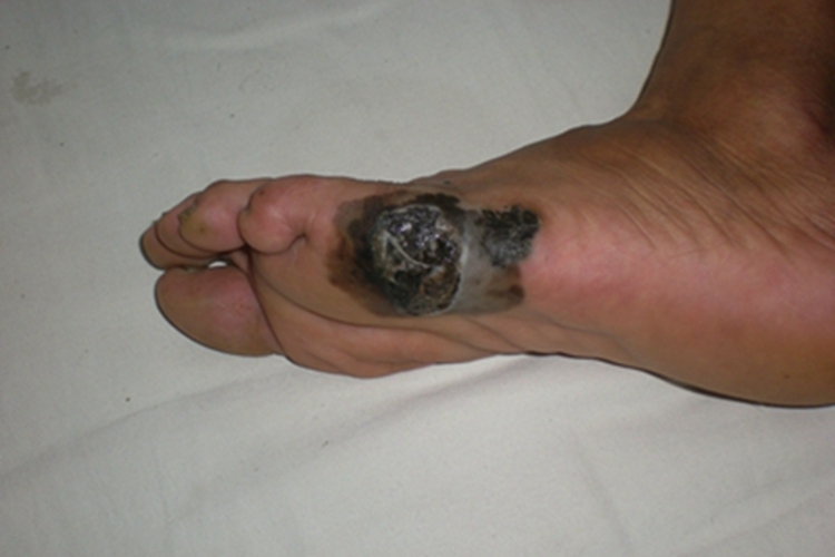 肢端雀斑痣样黑素瘤脚部症状图