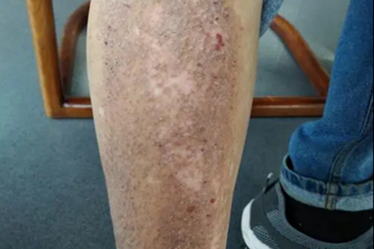 苔藓样淀粉样变病小腿长疹子图 苔藓样淀粉样变病小腿长疹子图