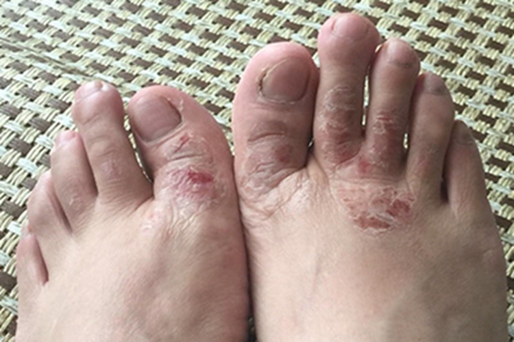 足癣脚背结痂图 足癣脚背结痂图