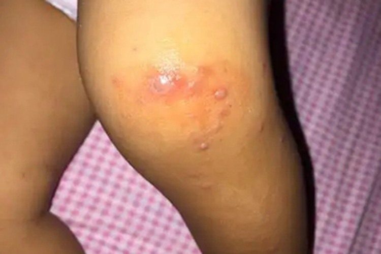 水痘膝盖红色斑疹图